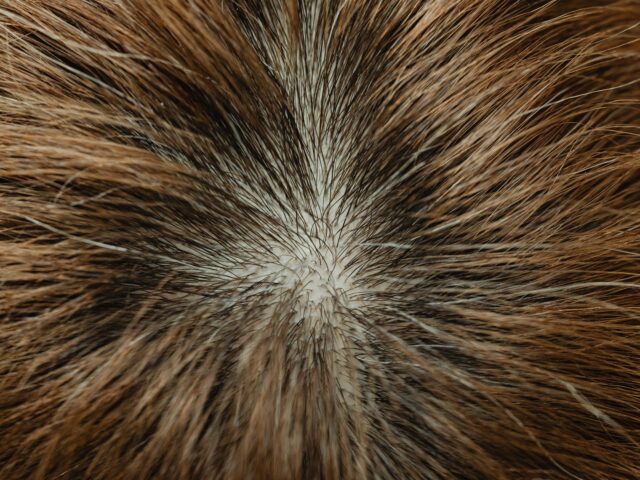 Minoxidil 2% Solution – Gentle Hair Regrowth Formula for Thinning Hair